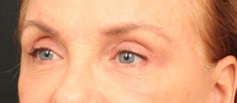 Brow / Temple Lift Before & After Image