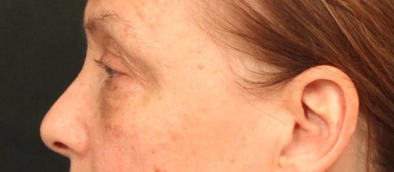 Brow / Temple Lift Before & After Image