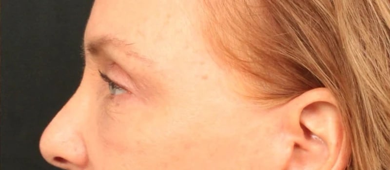 Brow / Temple Lift Before & After Image