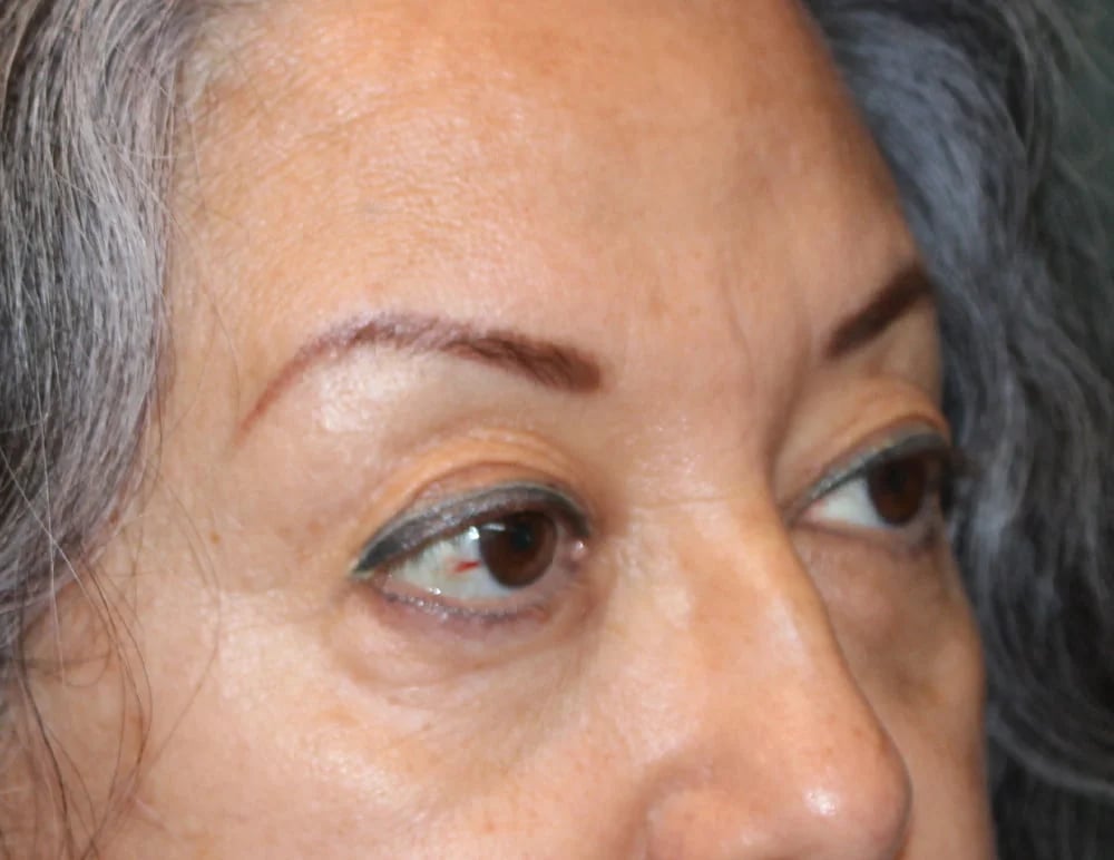 Lower Blepharoplasty Before & After Image