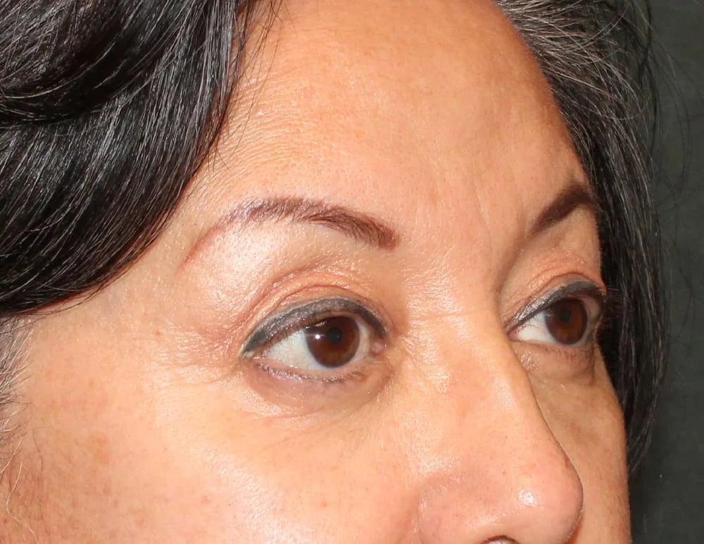 Lower Blepharoplasty Before & After Image