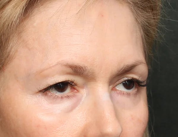Lower Blepharoplasty Before & After Image