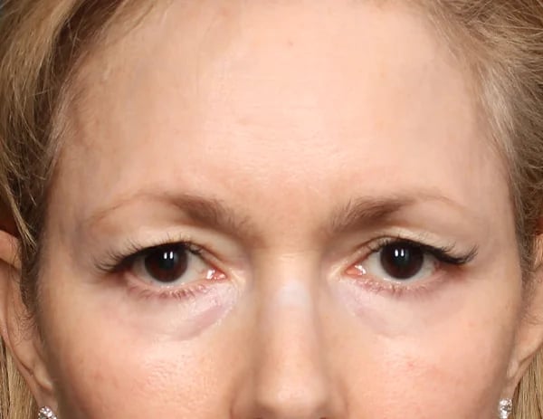 Lower Blepharoplasty Before & After Image