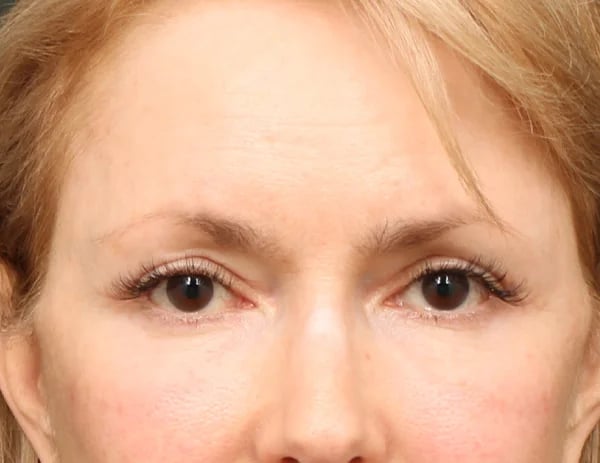 Lower Blepharoplasty Before & After Image