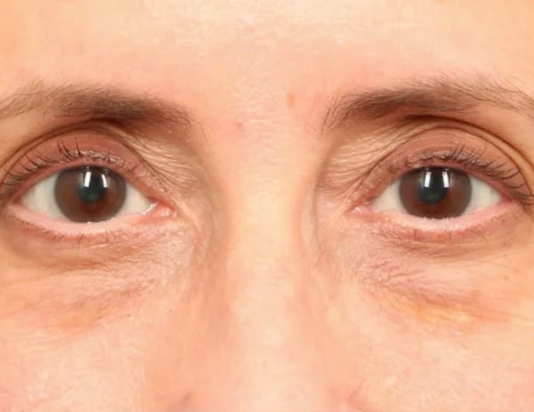 Lower Blepharoplasty Before & After Image