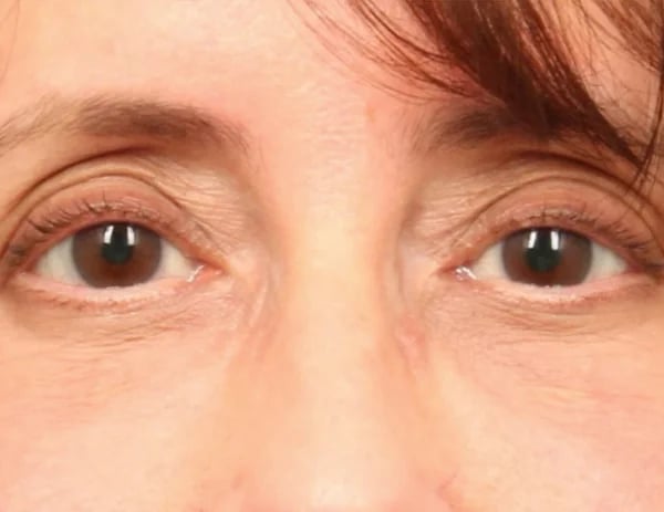 Lower Blepharoplasty Before & After Image