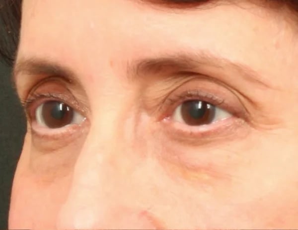Lower Blepharoplasty Before & After Image