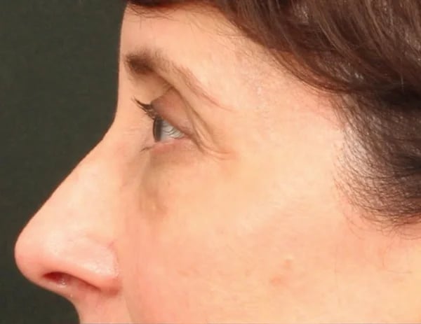 Lower Blepharoplasty Before & After Image