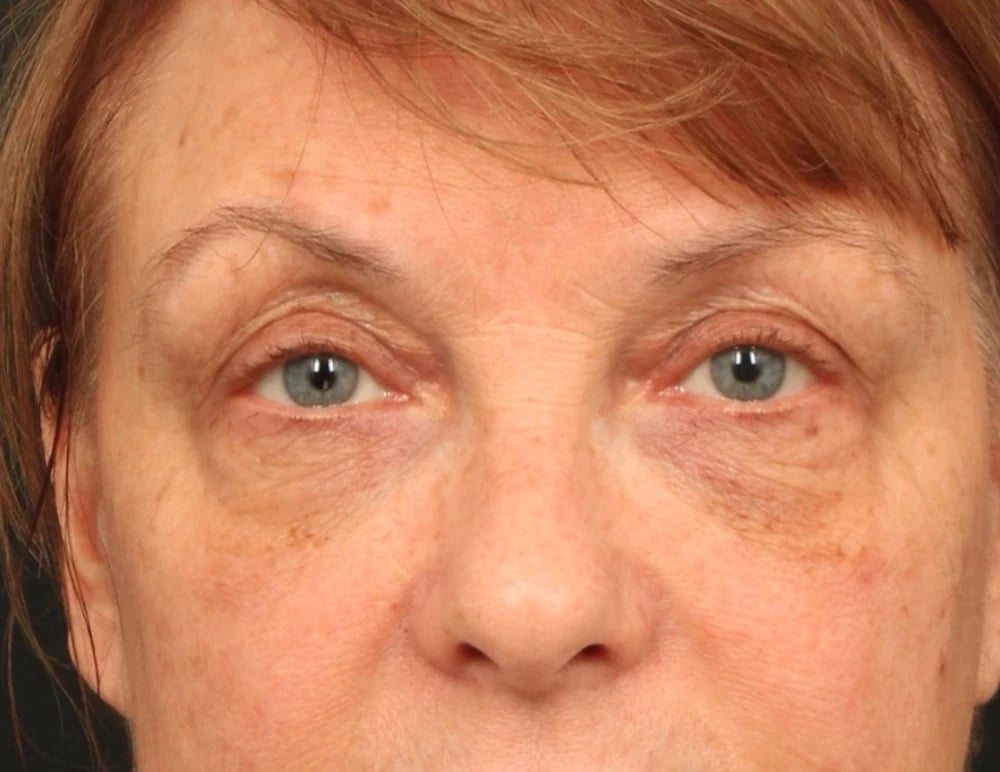 Lower Blepharoplasty Before & After Image