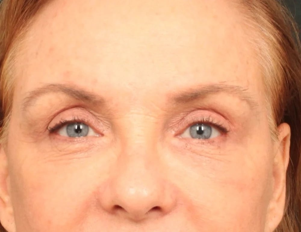 Lower Blepharoplasty Before & After Image