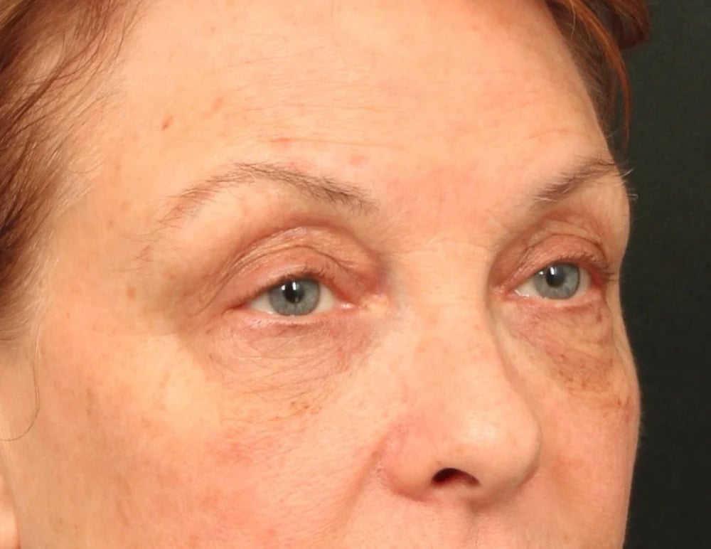 Lower Blepharoplasty Before & After Image