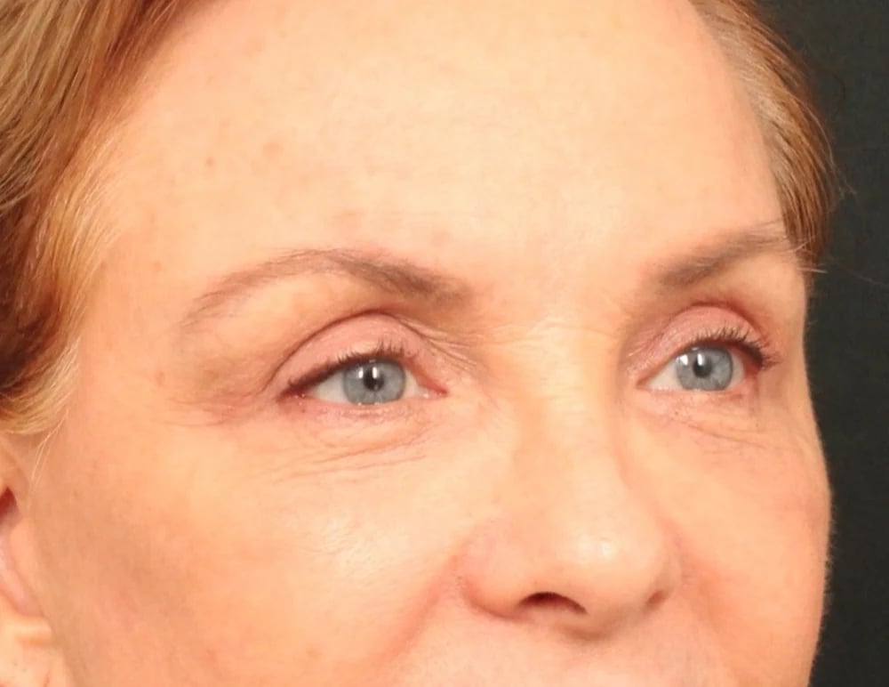 Lower Blepharoplasty Before & After Image