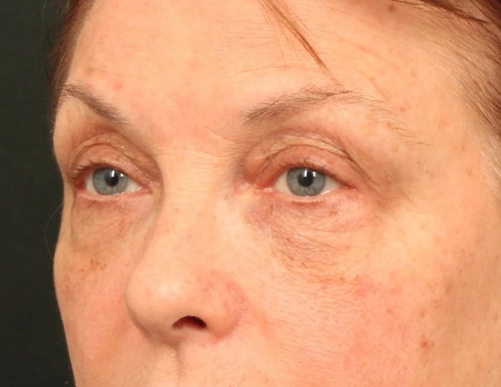 Lower Blepharoplasty Before & After Image
