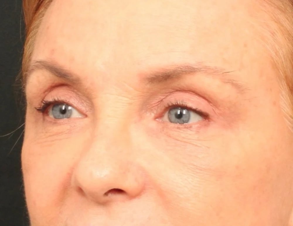 Lower Blepharoplasty Before & After Image