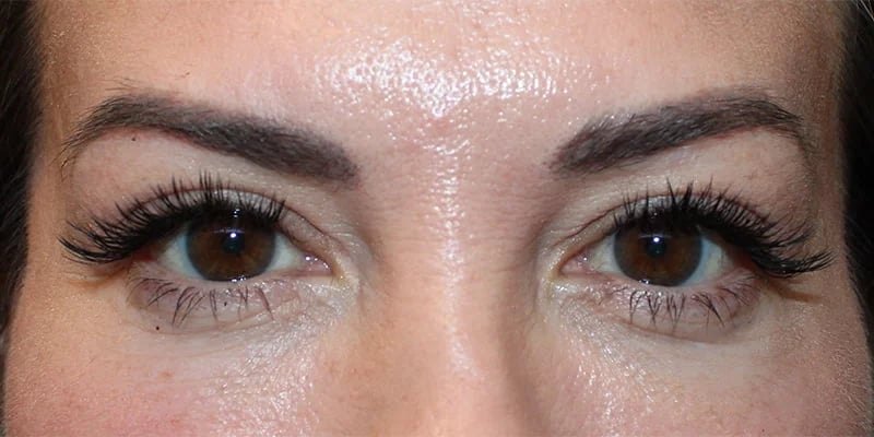 Upper Blepharoplasty Before & After Image