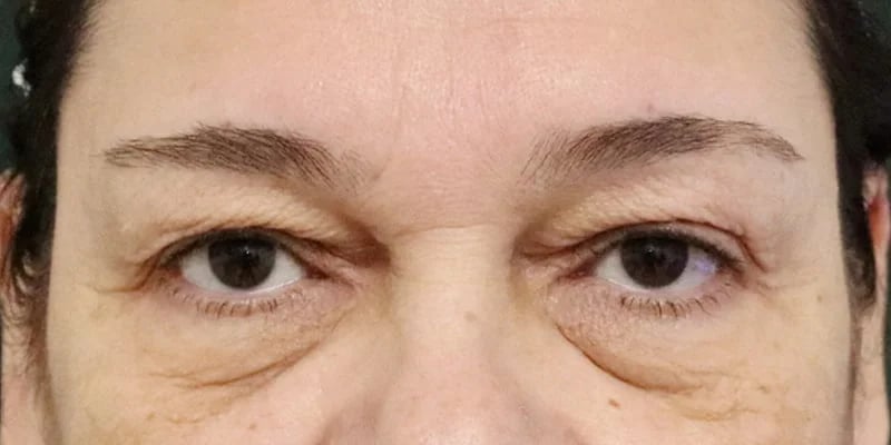 Upper Blepharoplasty Before & After Image