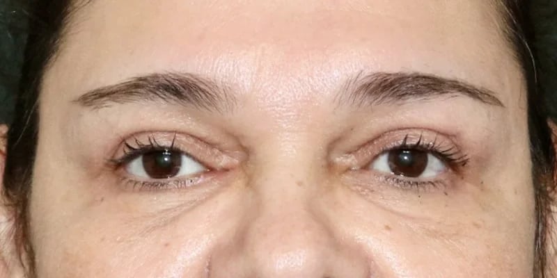 Upper Blepharoplasty Before & After Image