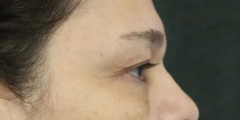 Upper Blepharoplasty Before & After Image