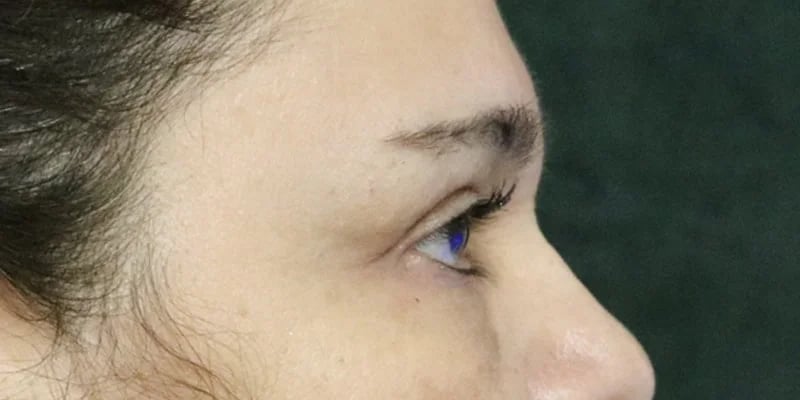 Upper Blepharoplasty Before & After Image