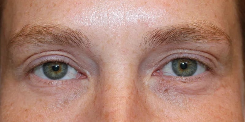 Upper blepharoplasty Before & After Image