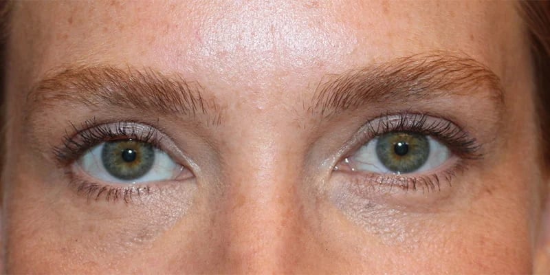Upper blepharoplasty Before & After Image