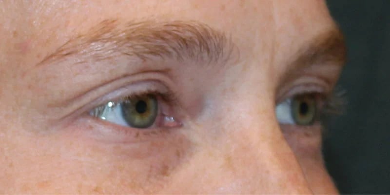 Upper blepharoplasty Before & After Image