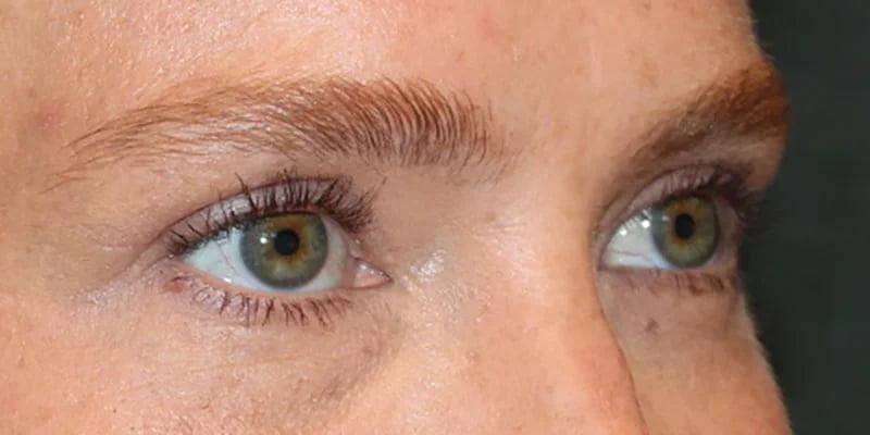 Upper blepharoplasty Before & After Image