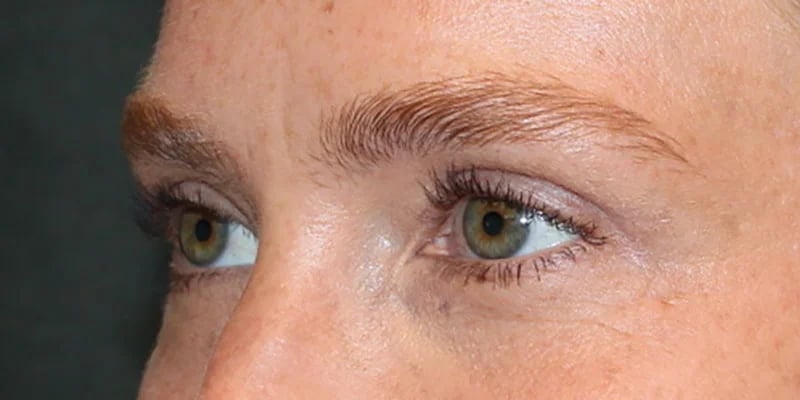 Upper Blepharoplasty Before & After Image