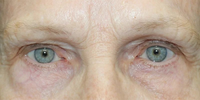 Upper blepharoplasty Before & After Image