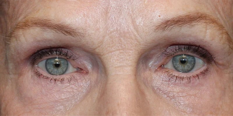 Upper blepharoplasty Before & After Image
