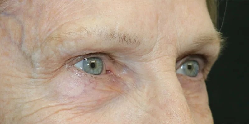 Upper blepharoplasty Before & After Image