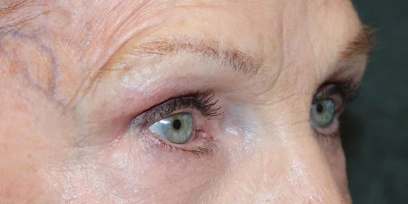 Upper blepharoplasty Before & After Image