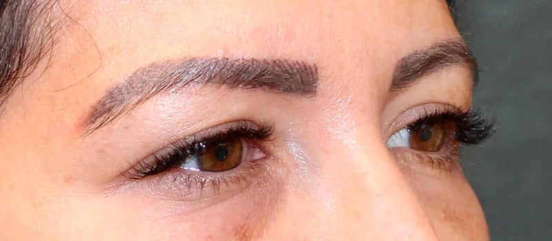 Upper Blepharoplasty Before & After Image