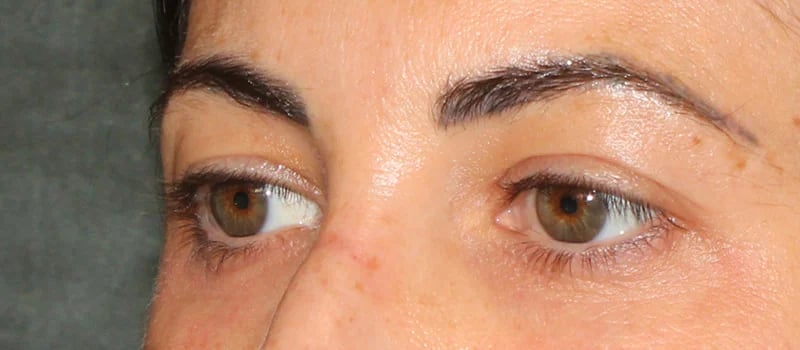 Upper Blepharoplasty Before & After Image