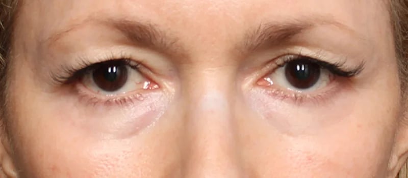 Upper Blepharoplasty Before & After Image