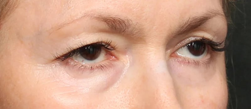 Upper Blepharoplasty Before & After Image