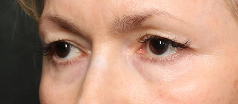 Upper Blepharoplasty Before & After Image
