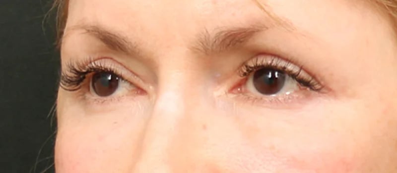 Upper Blepharoplasty Before & After Image