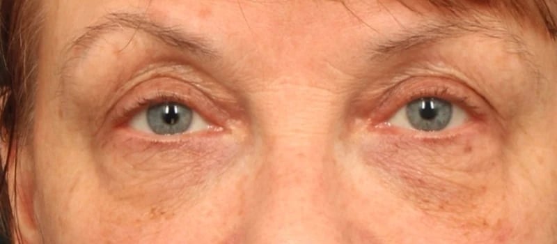 Upper Blepharoplasty Before & After Image