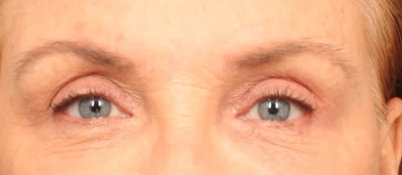 Upper Blepharoplasty Before & After Image