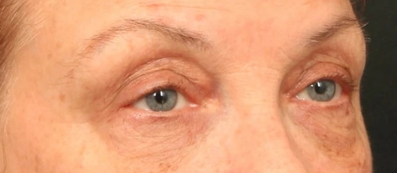 Upper Blepharoplasty Before & After Image