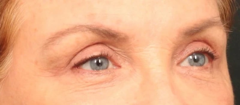 Upper Blepharoplasty Before & After Image