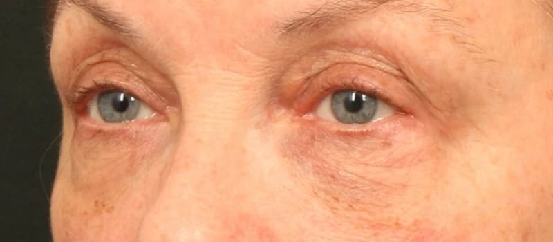 Upper Blepharoplasty Before & After Image