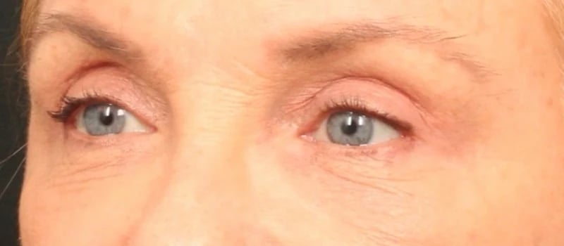 Upper Blepharoplasty Before & After Image