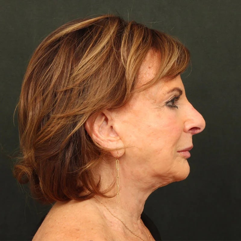 Deep plane facelift Before & After Image