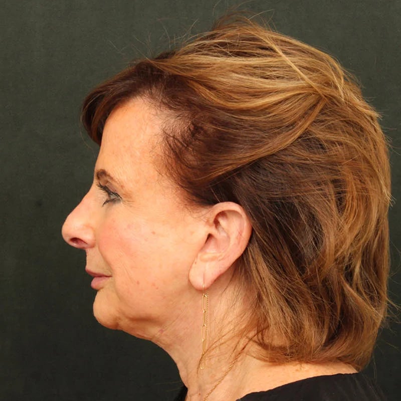 Deep Plane Facelift & Neck Lift Before & After Image