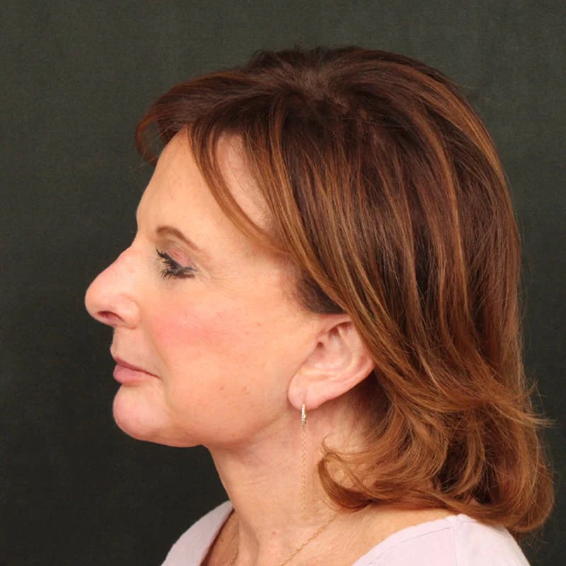 Deep Plane Facelift & Neck Lift Before & After Image