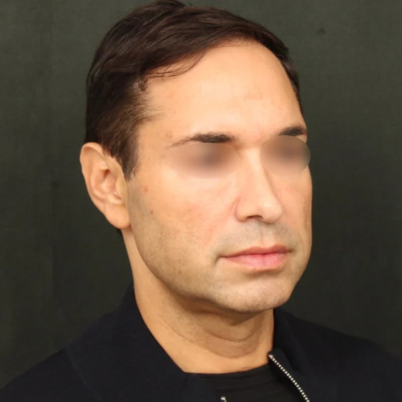 Deep plane facelift Before & After Image