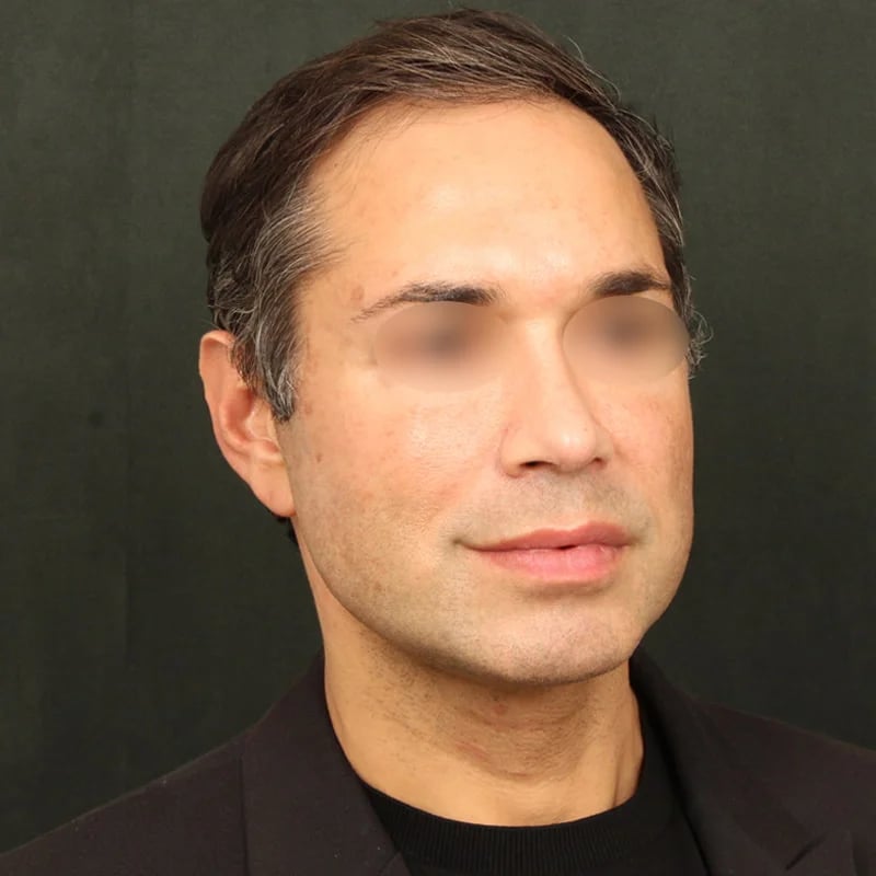Deep plane facelift Before & After Image