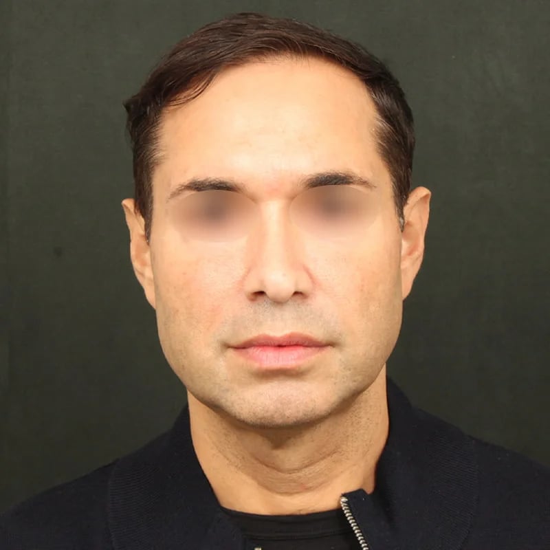 Deep plane facelift Before & After Image